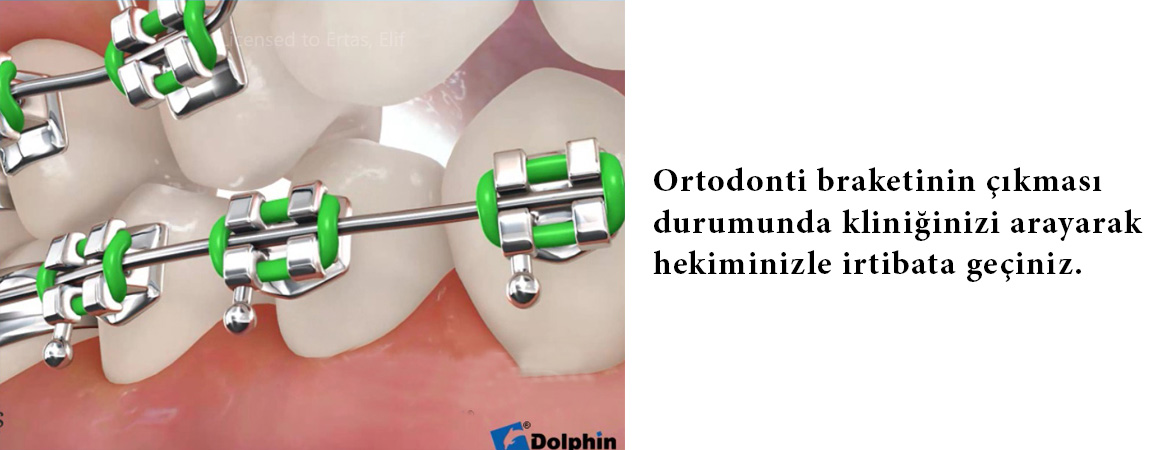 Tel Braketinin Çıkması