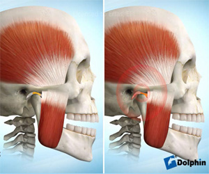 Alt Çene Eklem Bozuklukları